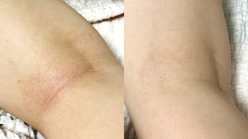 아토5분 2주 사용후기 아토피케어 하루 5분으로 우리아이 가려움 극복