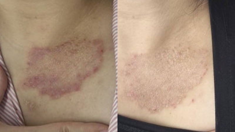 아토피 피부염 스테로이드 대체 아토5분 성인 아토피 가려움 사라진 경험