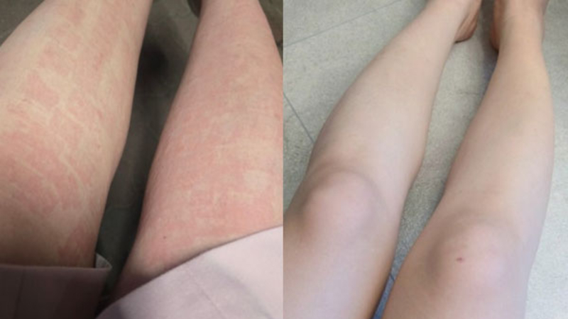 아토피 가려움 때문에 아토5분 사용해 본 솔직 후기