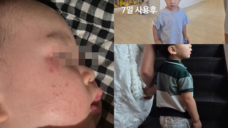 아토피피부염 아토피천연치료제 아기아토피관리