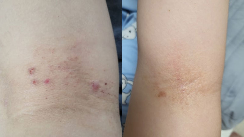 아토피 고민 끝 놀란바이오의 아토5분 직접 써본 솔직 후기