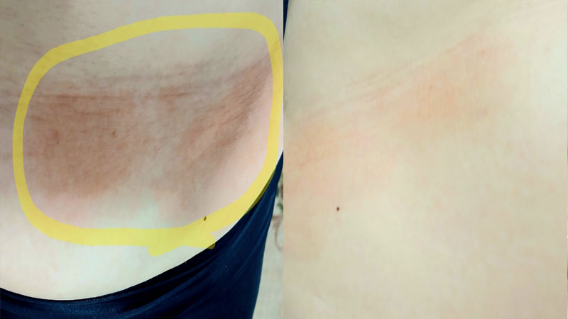 정말 5분도 채못되어 가려움이 멈추는것을 보았고 몇차례후엔 염증도 깨끗! 굿!