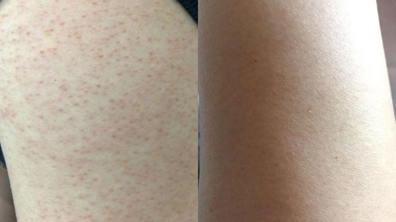 아토5분 유성 10ml, 천연 대나무 추출 오일로 경험한 피부 변화