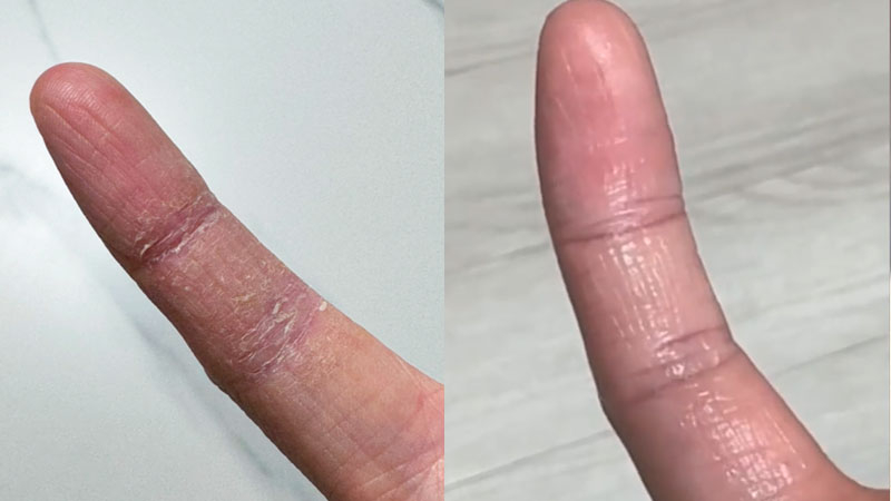 8년 손가락 아토피, 일주일 만에 가려움이 사라졌어요… 저도 안 믿겨요