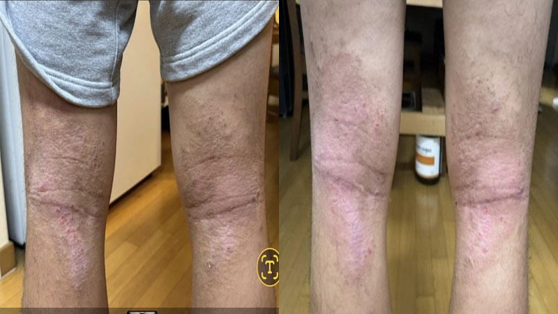 아토피 가려움, 천연 대나무 추출 항균 오일 놀란바이오 아토5분 유성 사용후기